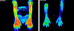 Inflammation thermal images